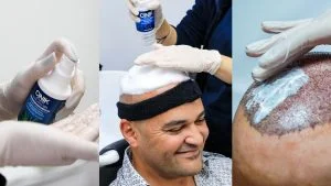 La Greffe de Cheveux après 10 jours : Évolutions et Précautions à Prendre