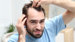 La calvitie précoce chez l'homme : causes, traitements et conseils