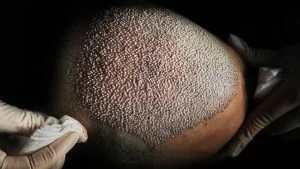 Croûtes après une greffe de cheveux : causes, durée et conseils