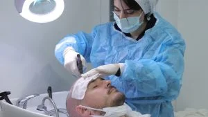Premier shampoing après une greffe de cheveux : comment procéder ?