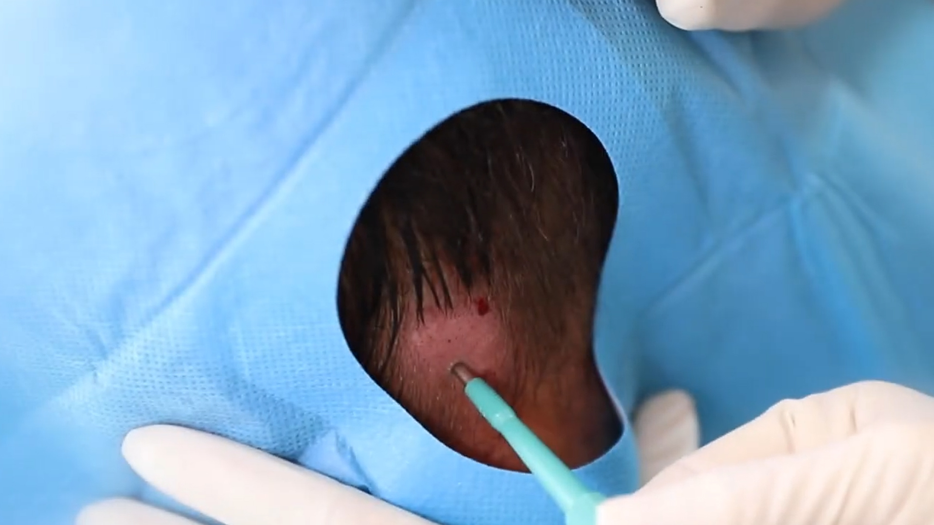 Prélèvement des cellules souches à l'aide d'un punch de biopsie dans le cadre d'une mesogreffe de cheveux Regenera Activa en Turquie 