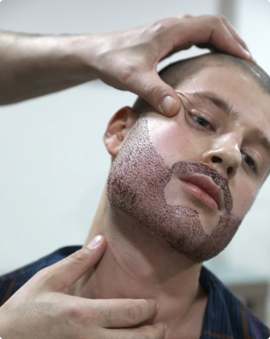 Greffe de Barbe