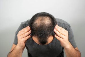 Quelles sont les causes d’une grosse chute de cheveux ?
