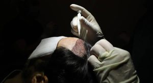 La technique direct hair implantation DHI