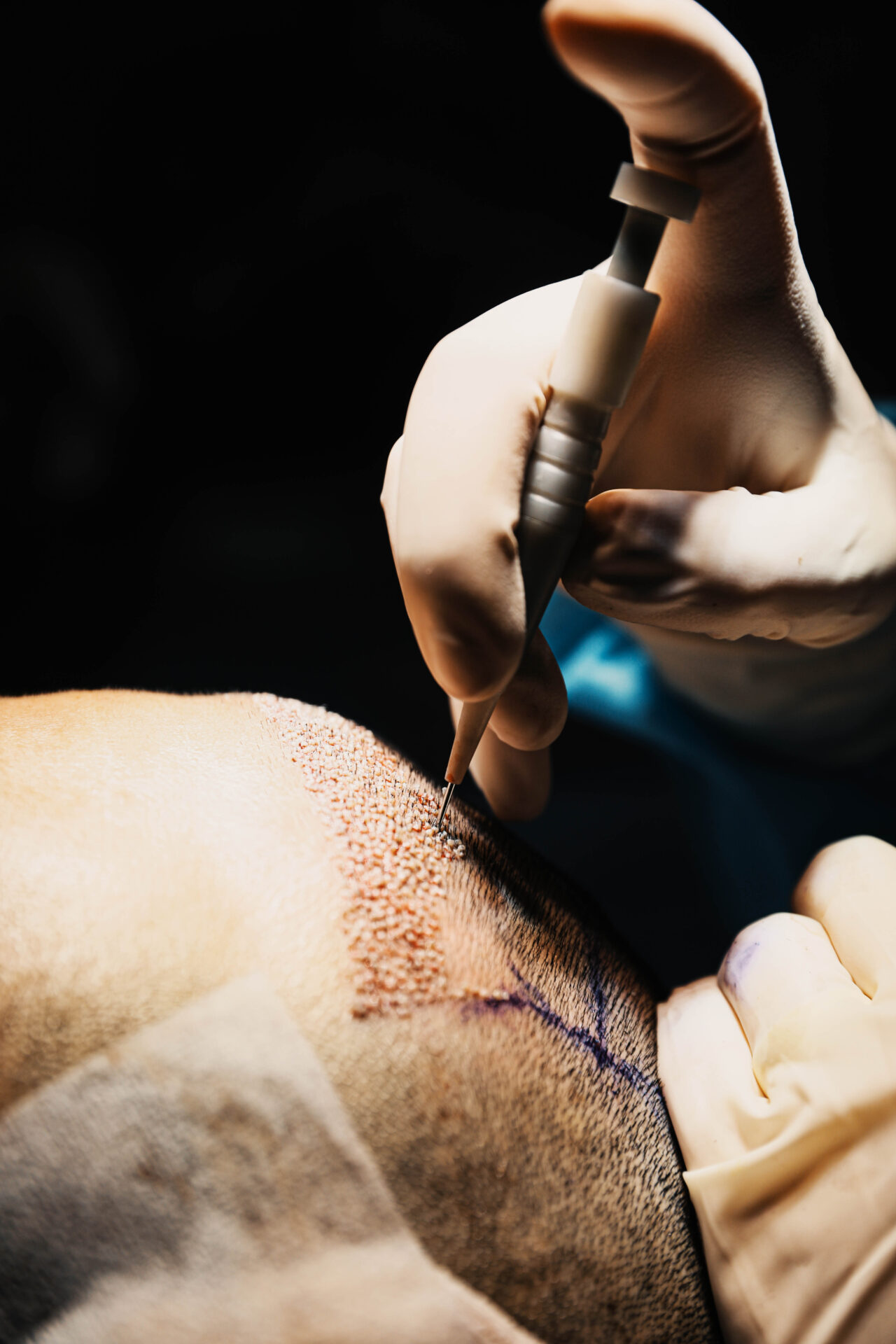 Un chirurgien implant les greffons dans le cadre d'une greffe de cheveux FUE Saphir