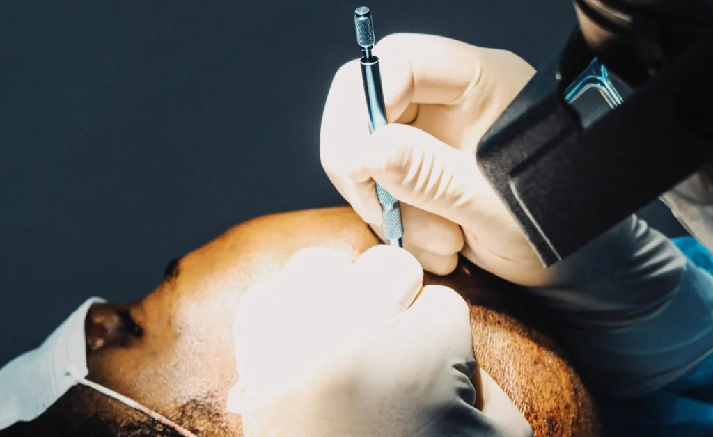 procédure greffe de cheveux