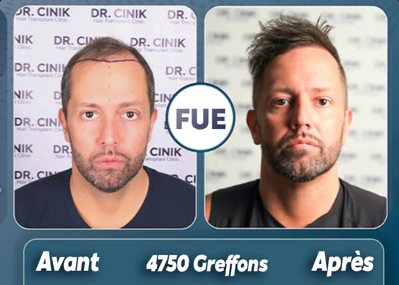 Avant-Apres-4750-greffons