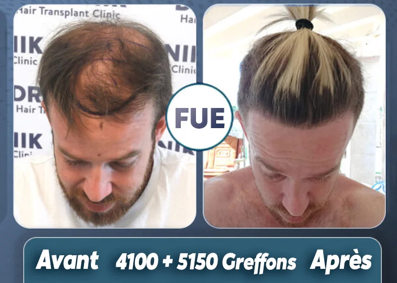 Avant-Apres-9250-greffons