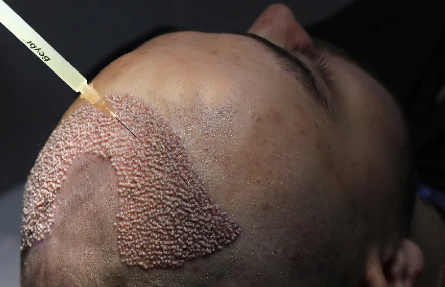Une injection PRP suite à une greffe de cheveux